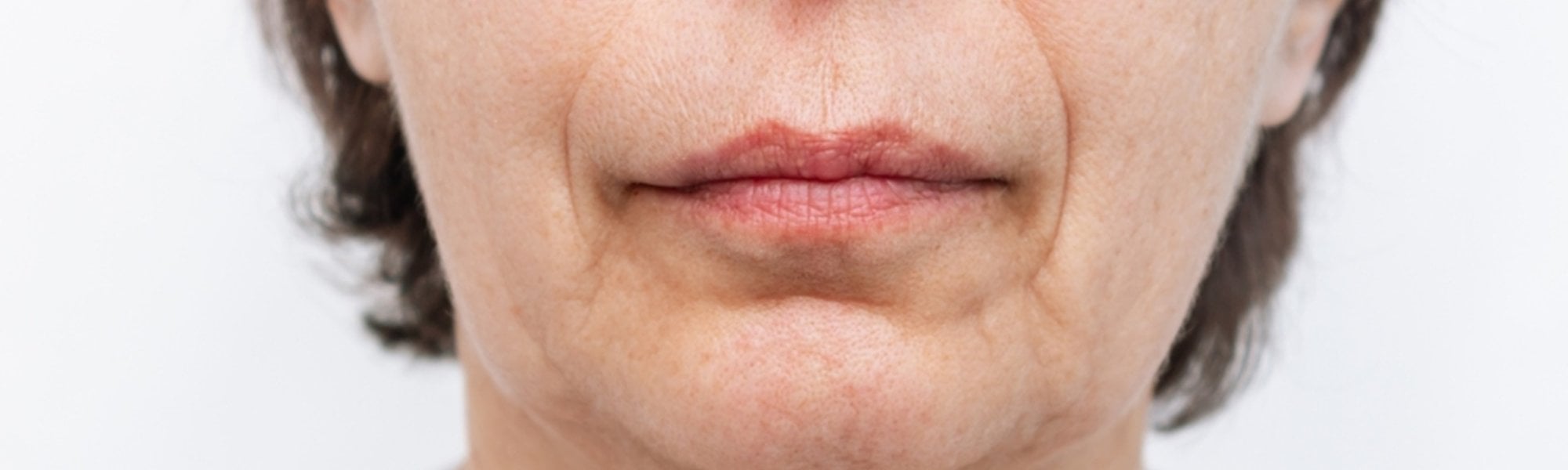 Flacidez Facial Como Prevenir