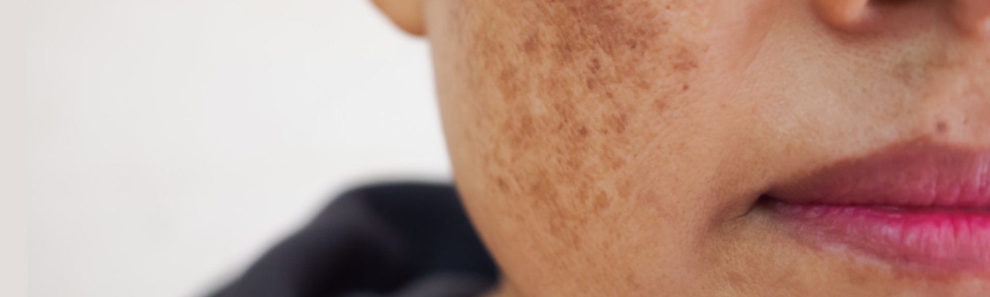 O que é melasma? Entenda como pode surgir e como tratar