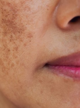 O que é melasma? Entenda como pode surgir e como tratar