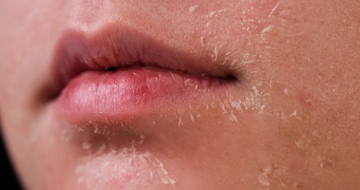 Entenda e trate a pele descascando corretamente | L'Oréal Paris