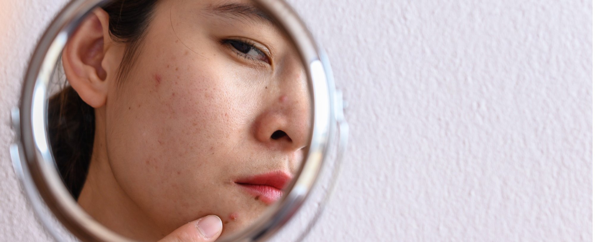Moça com mancha de acne se olhando no espelho