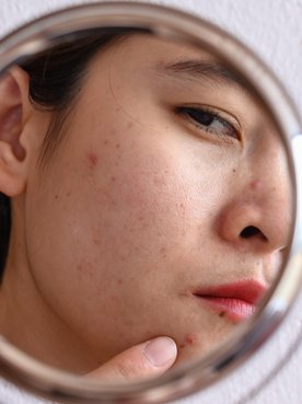 Moça com mancha de acne se olhando no espelho