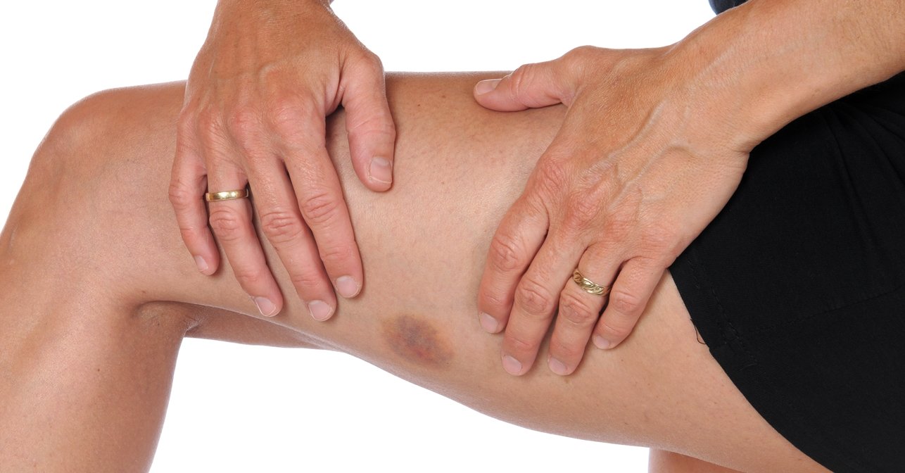 imagem de uma perna de mulher, com um hematoma na coxa.