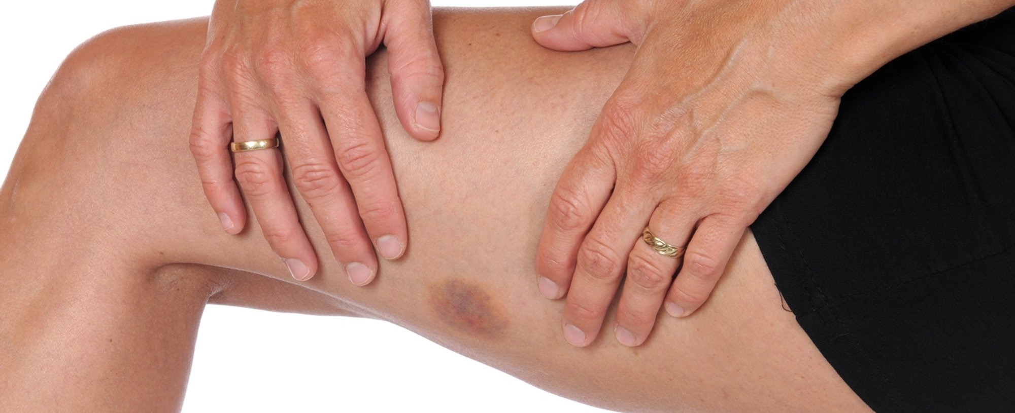 imagem de uma perna de mulher, com um hematoma na coxa.