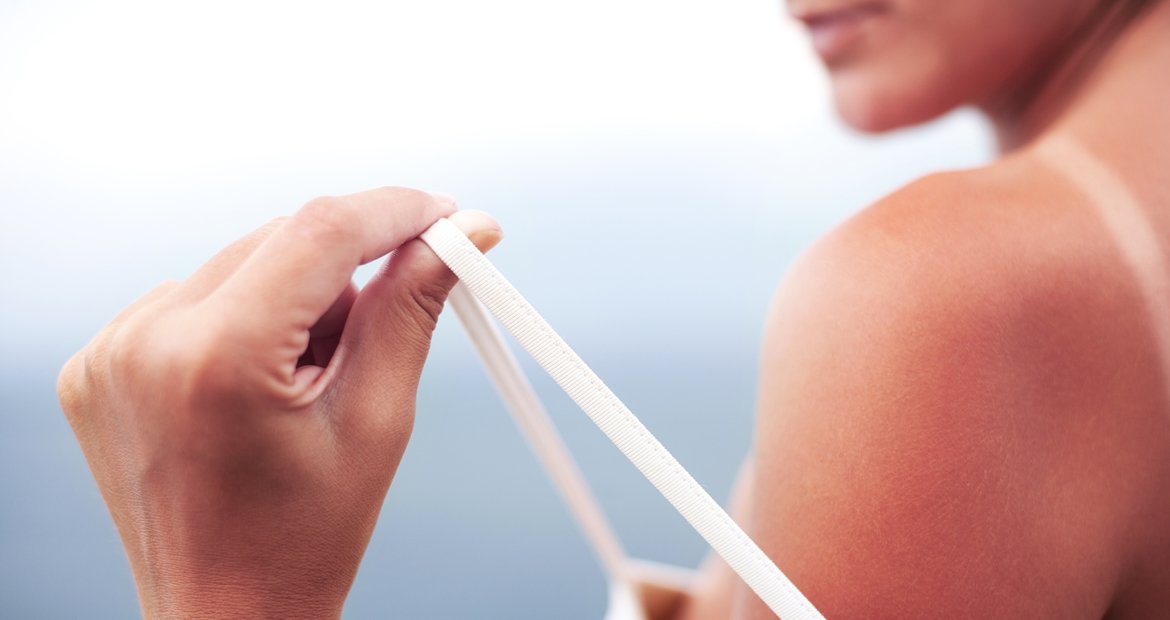 Queimadura do sol dermatologista fala como evitar e como aliviar a dor