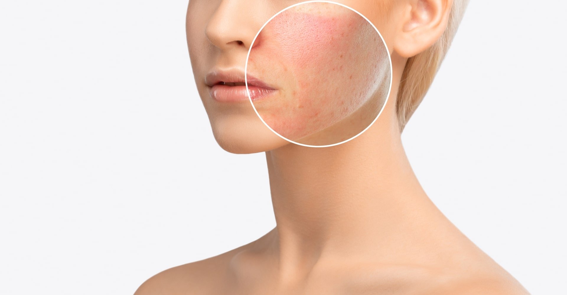 Queimadura do sol dermatologista fala como evitar e como aliviar a dor