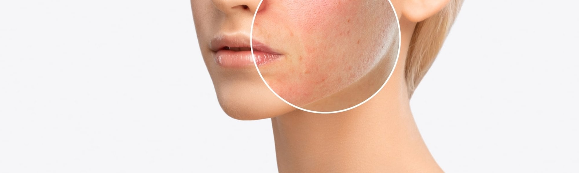 Queimadura do sol: dermatologista fala como evitar e como aliviar a dor