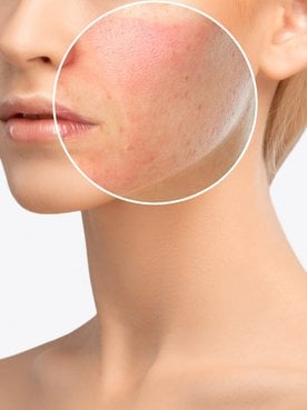 Queimadura do sol: dermatologista fala como evitar e como aliviar a dor