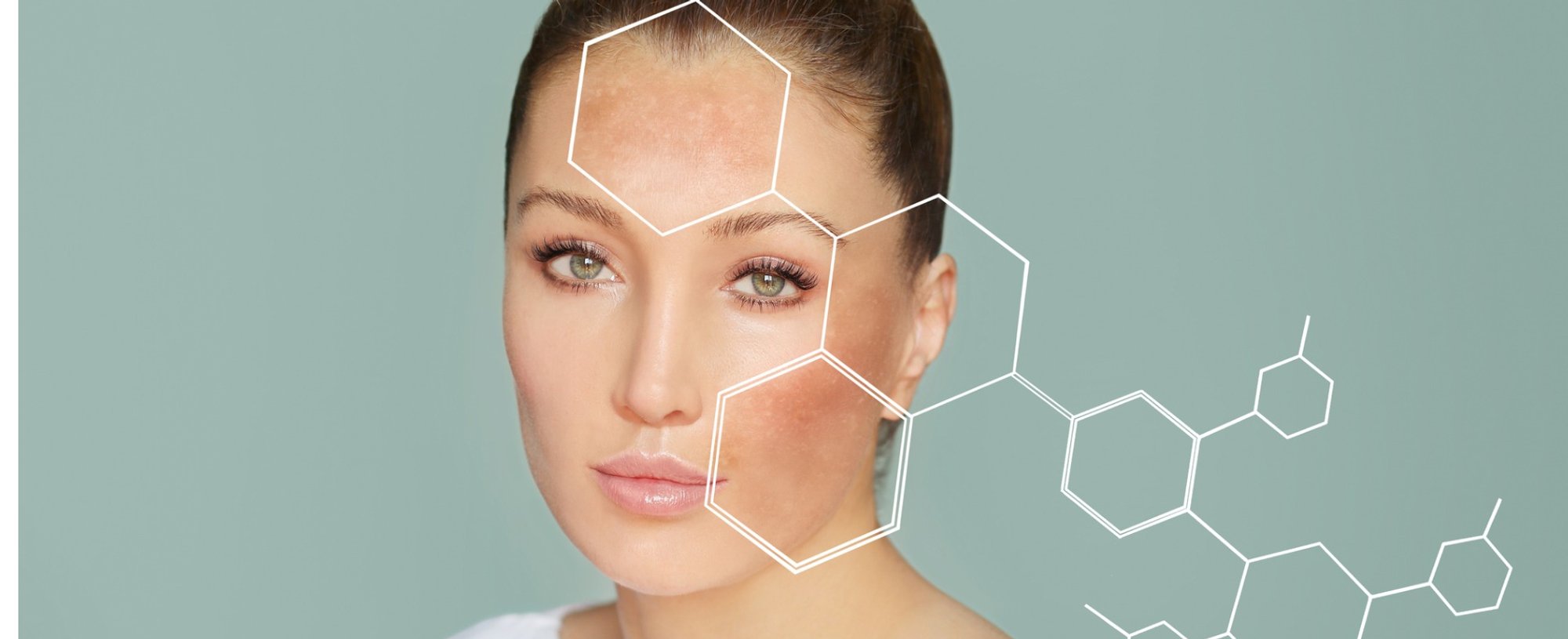 Dark Spots Freckleshyperpigmentationconcept Skin Lightening Skin Picture Id1270228406