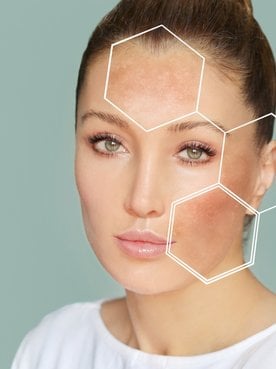 Dark Spots Freckleshyperpigmentationconcept Skin Lightening Skin Picture Id1270228406