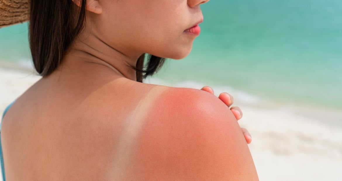 Mulher apresenta queimaduras de sol por não usar protetor solar corporal